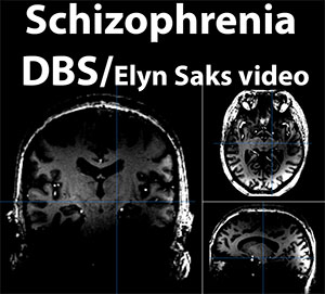 schizophrenia dbs image