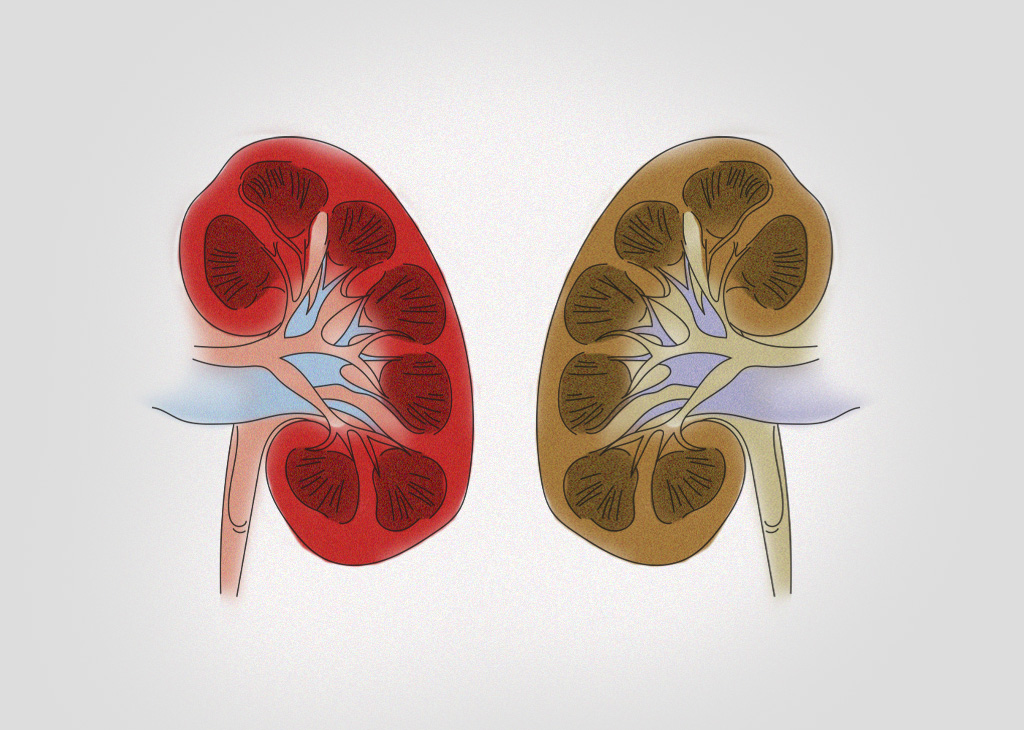 healthy-unhealthy-kidney-illustration