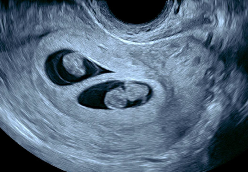ultrasound showing two distinct gestational sacs