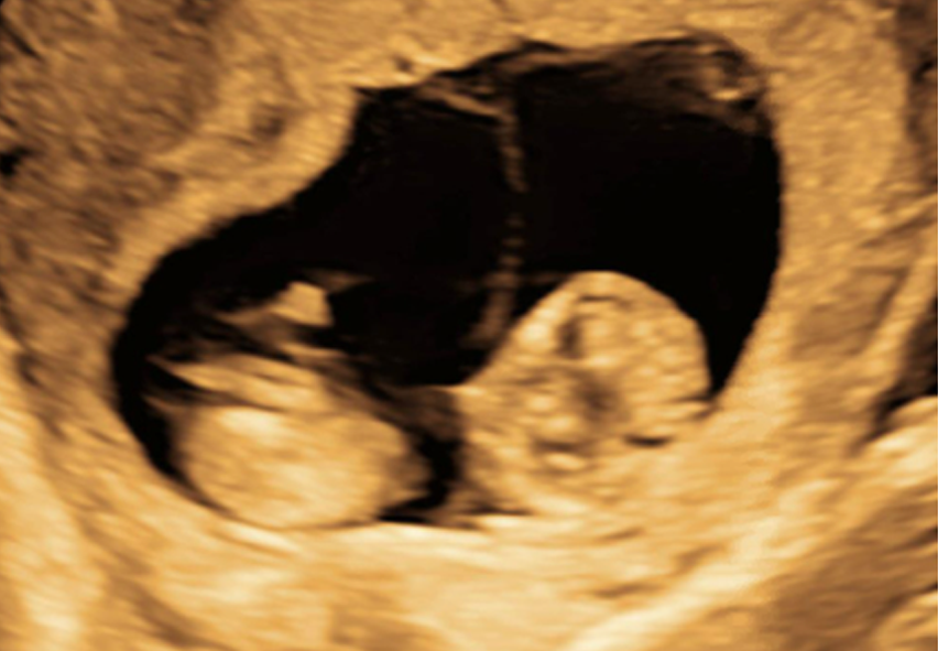 ultrasound showing monochorionic gestation