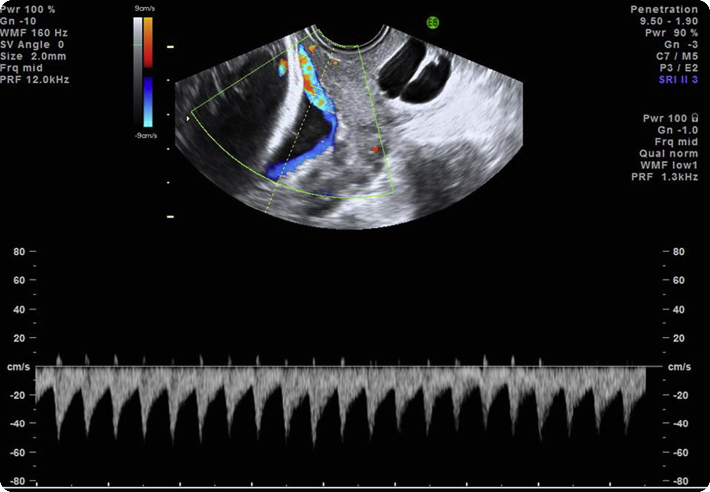 Image of vasa previa.