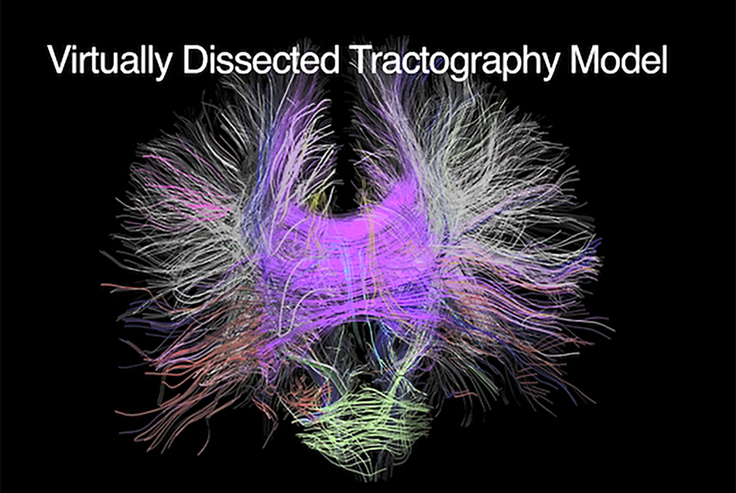 3D Brain Tractography