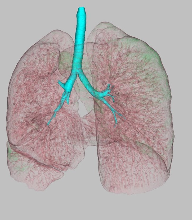 lung 3D