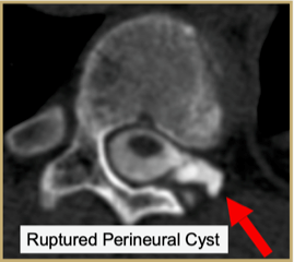 Ruptured Perineural Cyst