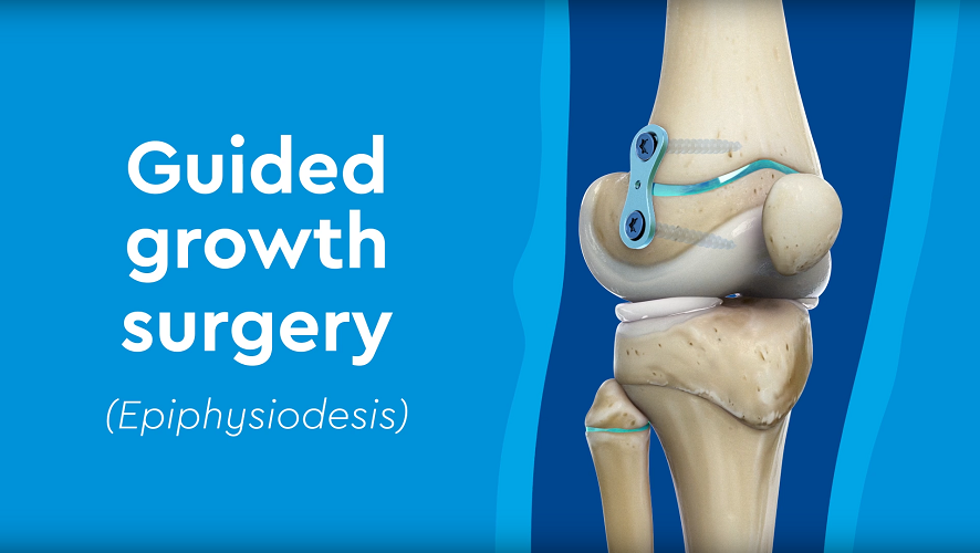 Guided growth surg
