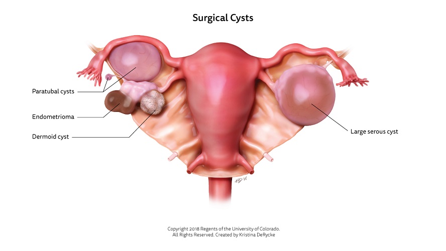 Surgical-Cysts-2