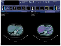 lung-cancer-4