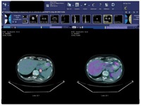 lung-cancer-4