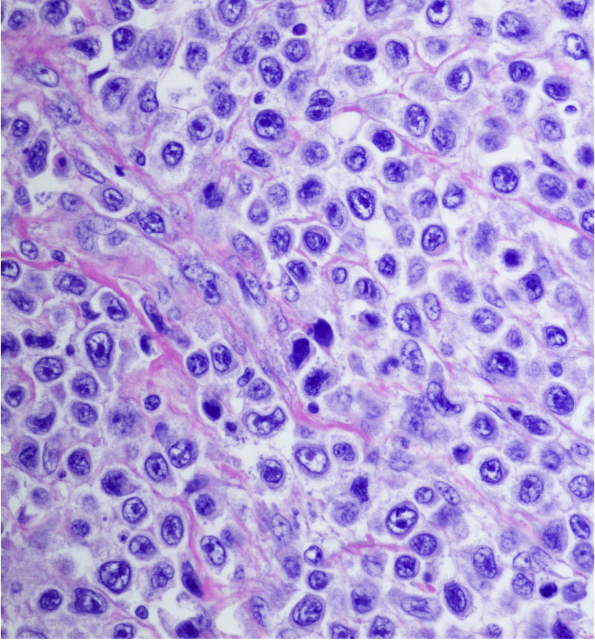 B-cell lymphoma