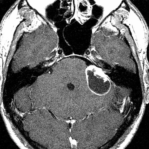 Acoustic Neuroma