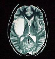 Adult Brain Tumor Main Page