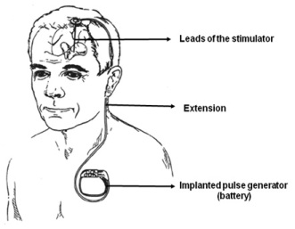 Department Of Neurosurgery Deep Brain Stimulation