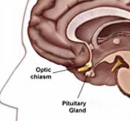 Pituitary Tumor