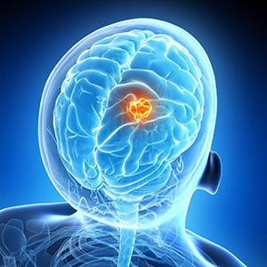 neuro oncology illustration of tumor in brain