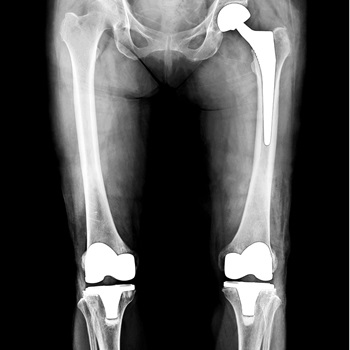 Joint Replacement, Hip & Knee