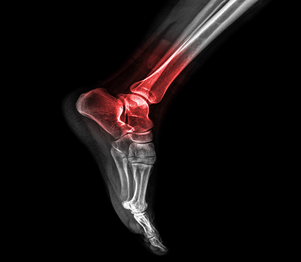 Ankle Pain,  T.Jay Kleeman, MD, Foot & Ankle Specialist