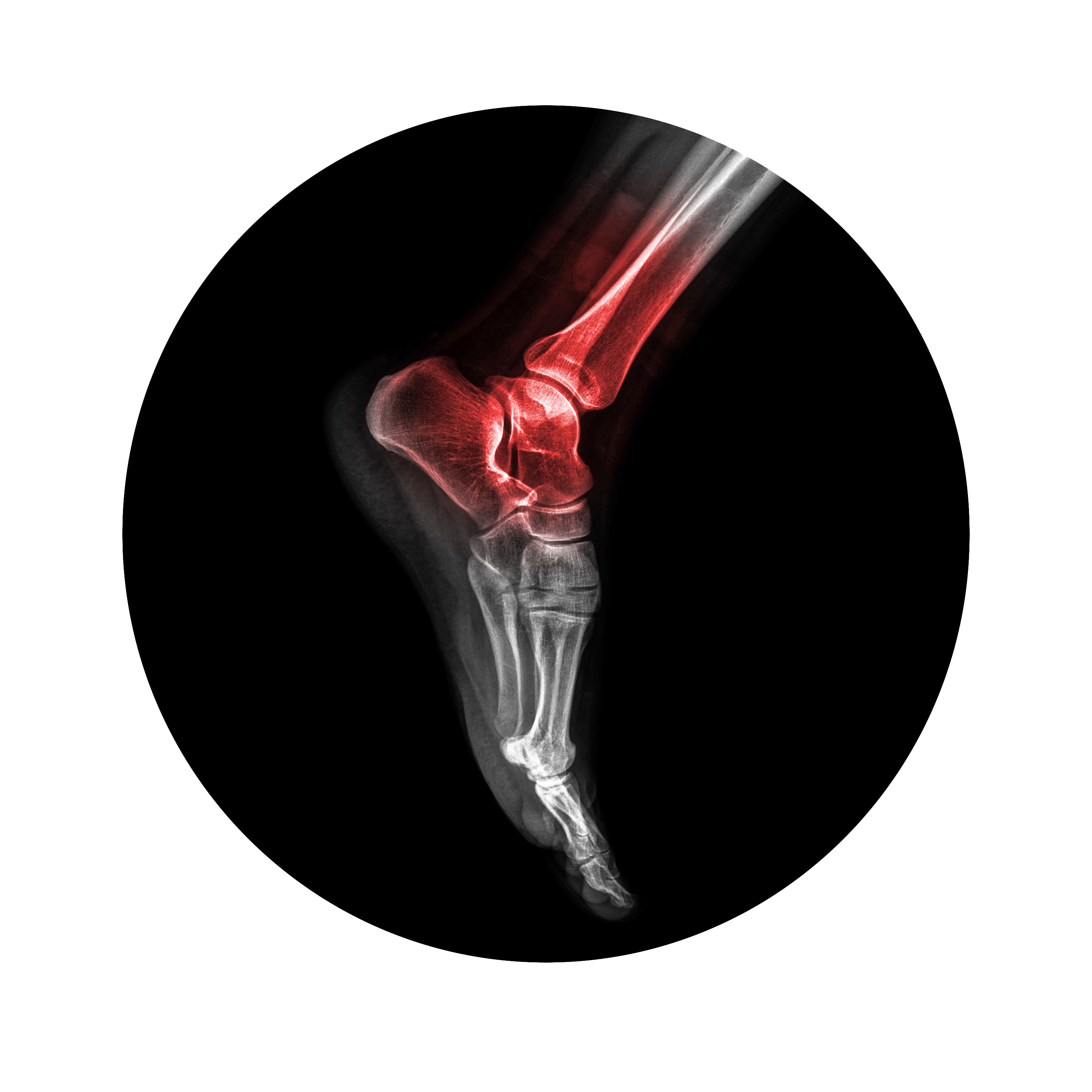 Acute Injuries, sports Medicine