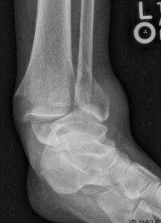 Ankle Fracture-2