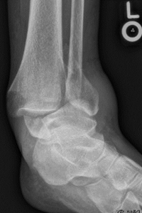 Ankle Fracture-2