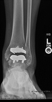 AP and lateral radiographs after total ankle replacement surgery-1