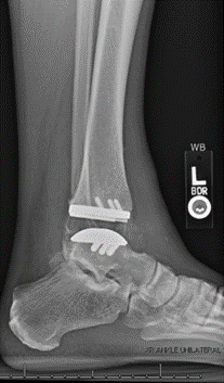 AP and lateral radiographs after total ankle replacement surgery-2