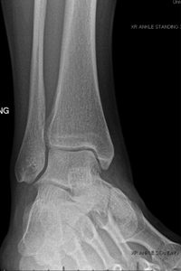 Figure 1-Normal ankle joint