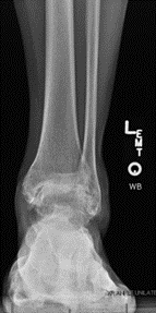 Figure 2-AP and lateral radiographs of post-traumatic ankle arthritis-1