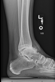 Figure 2-AP and lateral radiographs of post-traumatic ankle arthritis-2