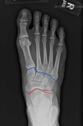 Foot Fracture-1