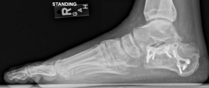 Foot Fracture-4