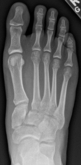 Foot Fracture-9