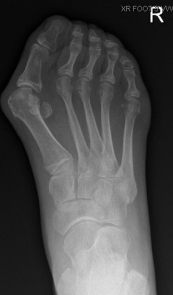 Hallux valgus-bunion deformity