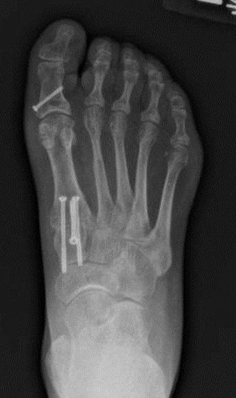 Lapidus bunionectomy