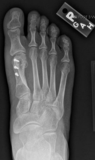 post-operative bunion correction