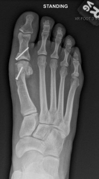 post-operative bunion correction