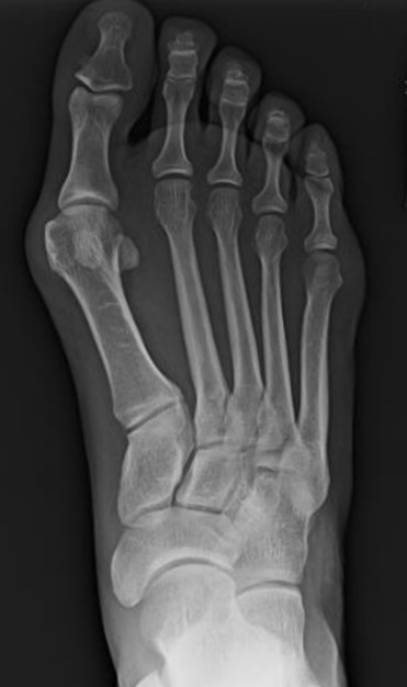 pre-operative weightbearing radiographs bunion deformity