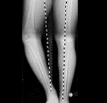 Genu Varum (knock knees), Genu Valgum (bowleg), Nonunions and Malunions, Arthrogryposis