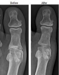 Interpositional Arthoplasty-Before-After