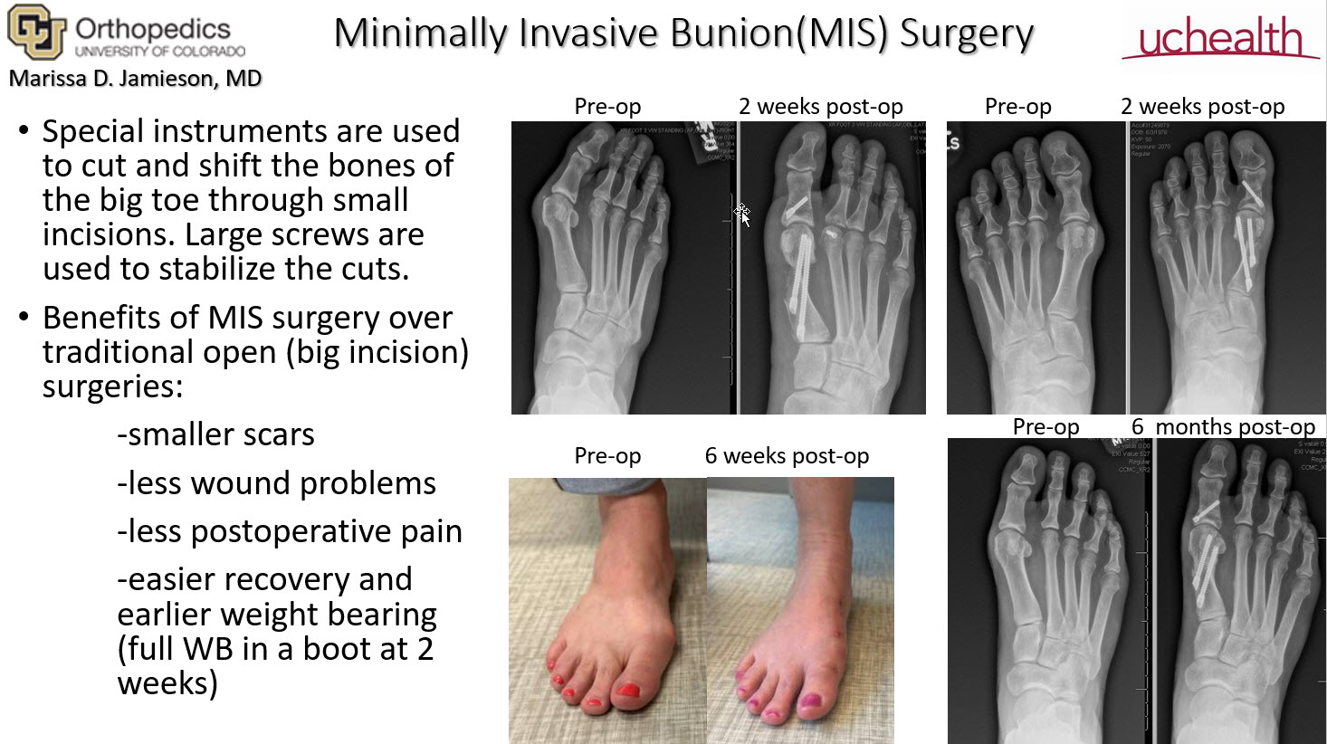 Minimally Invasive Surgery (MIS)