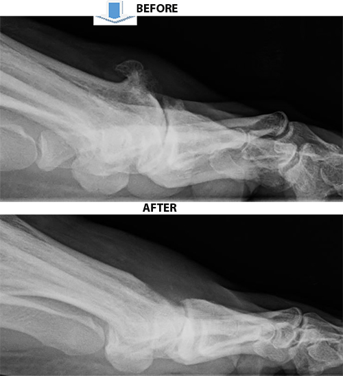 Before and after X-rays of a cheilectomy performed by Dr. Marissa Jamieson