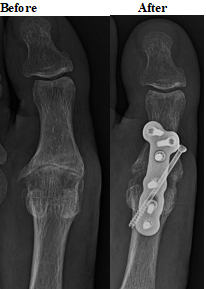 Before and after X-rays of a great toe fusion with plate and screws