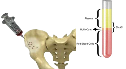 BMAC=Bone Marrow Aspirate Concentrate, PRP-Platelet Rich Plasma