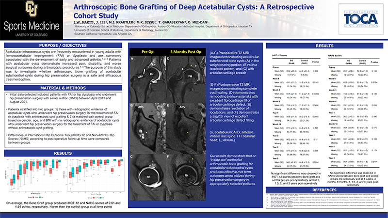 Arthroscopic Bone Grafting of Deep Acetabular Cysts A Retrospective Cohort Study_Marty