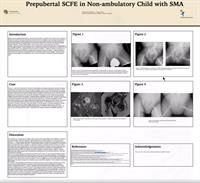 Prepubertal SCFE in Non-ambulatory Child with SMA