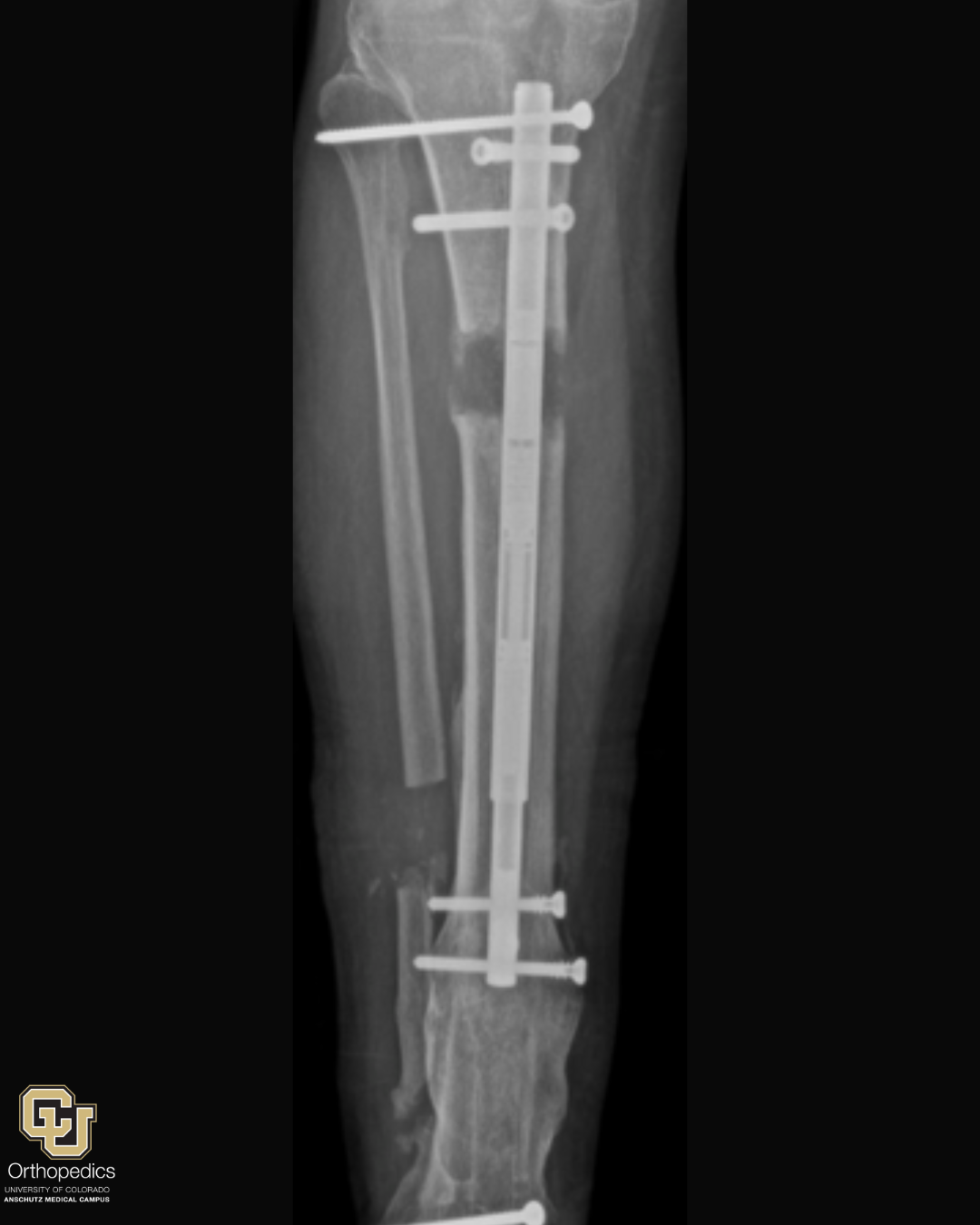 University of Colorado Limb Restoration Program -  Limb Length Discrepancies Bone Transport