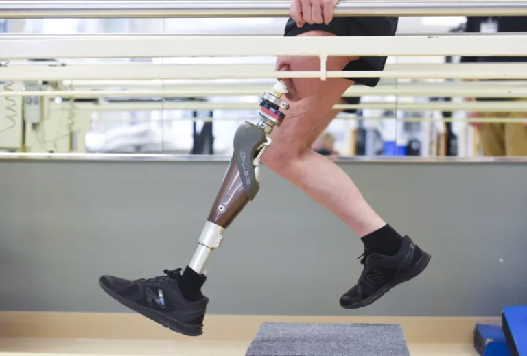 Innovative prosthetics center transforms care for amputees