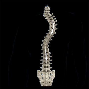 Scoliosis of the Spine