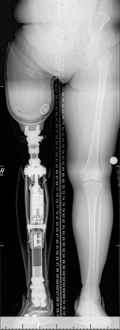 University-Colorado-Osseointegration-Prosthetic-Stoneback-Limb-Restoration-26
