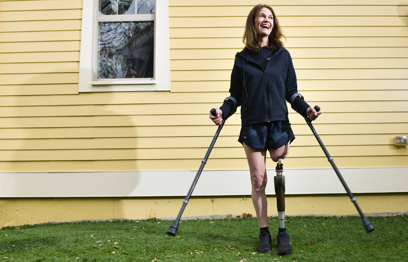 Osseointegration surgery gives amputee hope for better, faster, stronger life