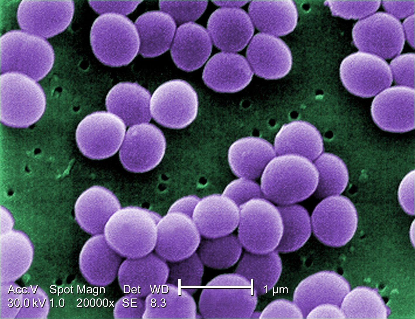 Staphylococcus-Spine Infection Diagnosis